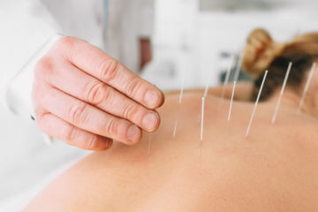 Acupuncture / Dry Needling